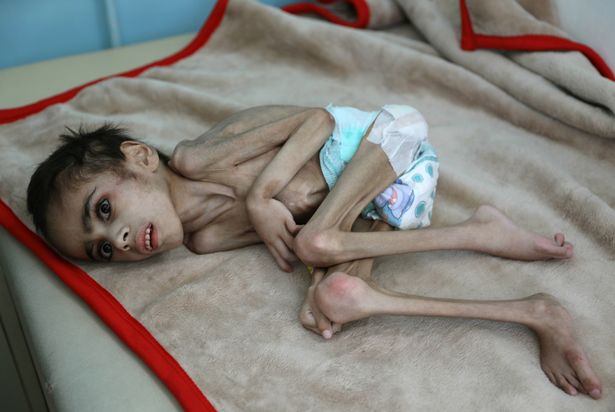 2_Faid-Samim-7-a-malnourished-boy-who-also-has-cerebral-palsy-lies-on-a-bed-at-the-malnutrition-tre